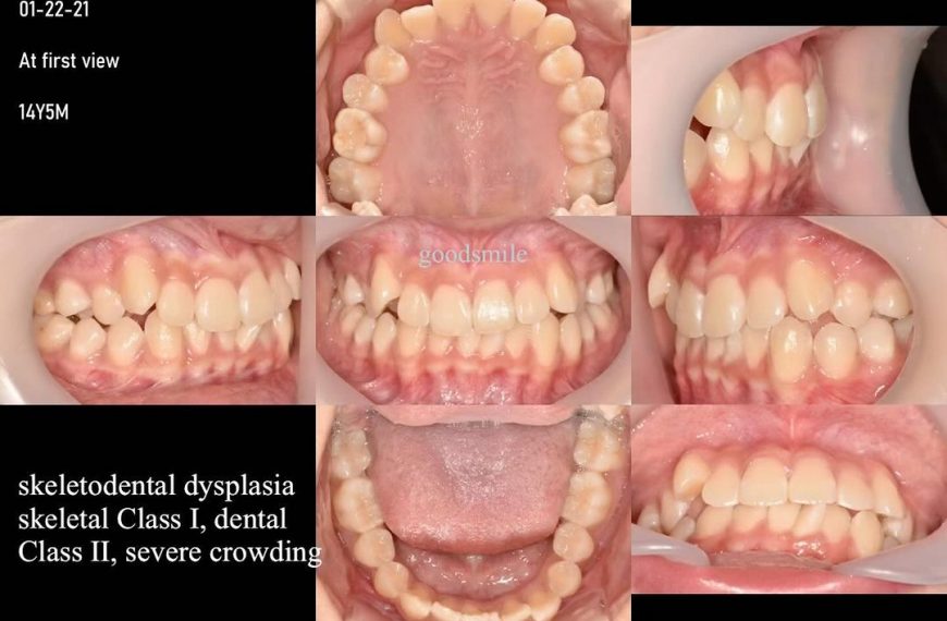 Camouflage treatment of dental Class II with sever…