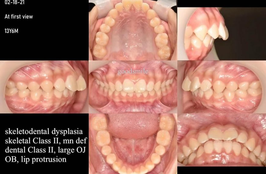 Treatment of skeletodental Class II, dental Class …