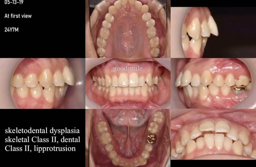 Camouflage treatment of skeletal Class II, hyperdi…