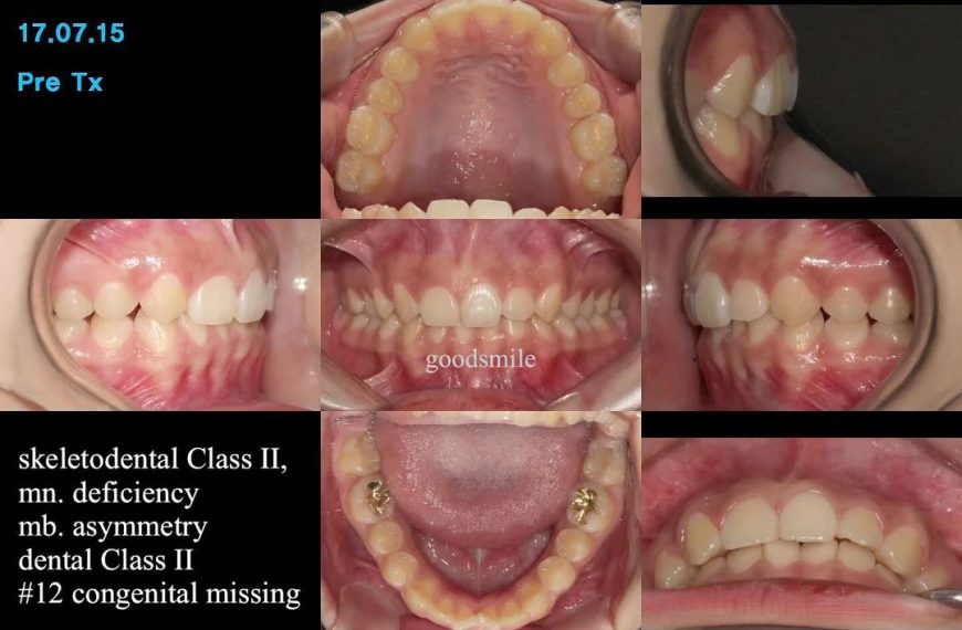 Camouflage treatment of skeletal asymmetry, dental…