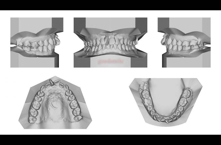 Camouflage treatment of skeletal Class II, dental …