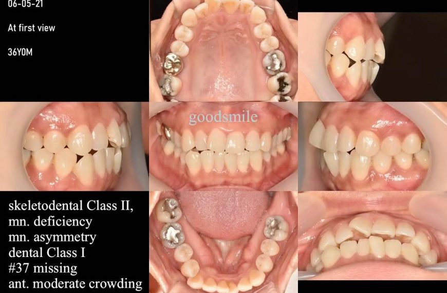 Camouflage treatment of skeletodental Class II, de…