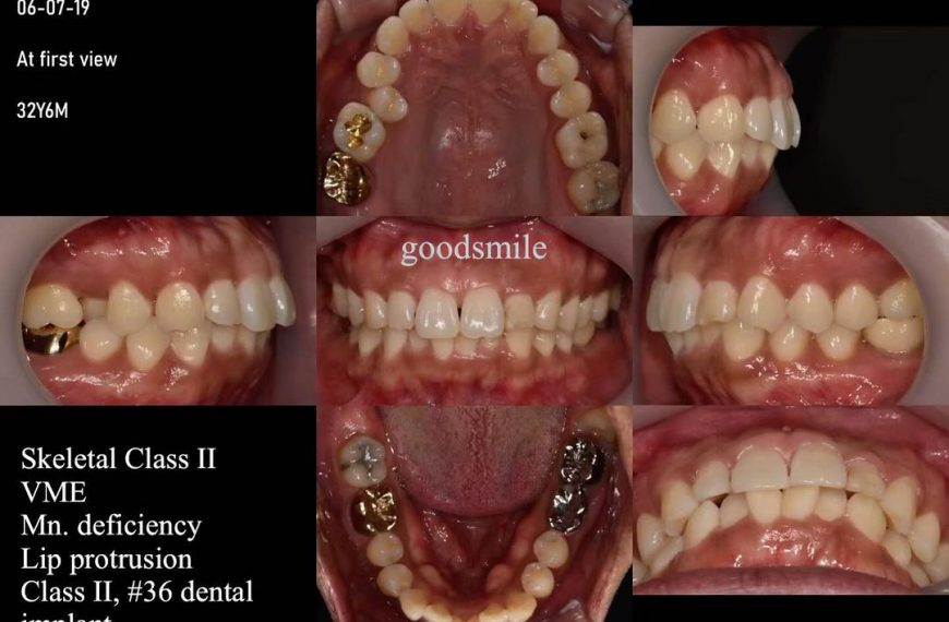 Treatment of skeletodental Class II, dental Class …