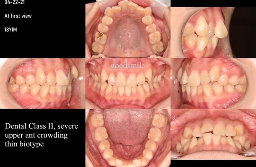 Treatment of dental Class II with severe anterior …