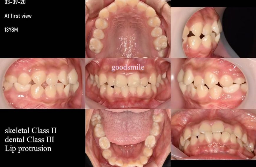 Treatment of skeletal Class II, dental Class III w…