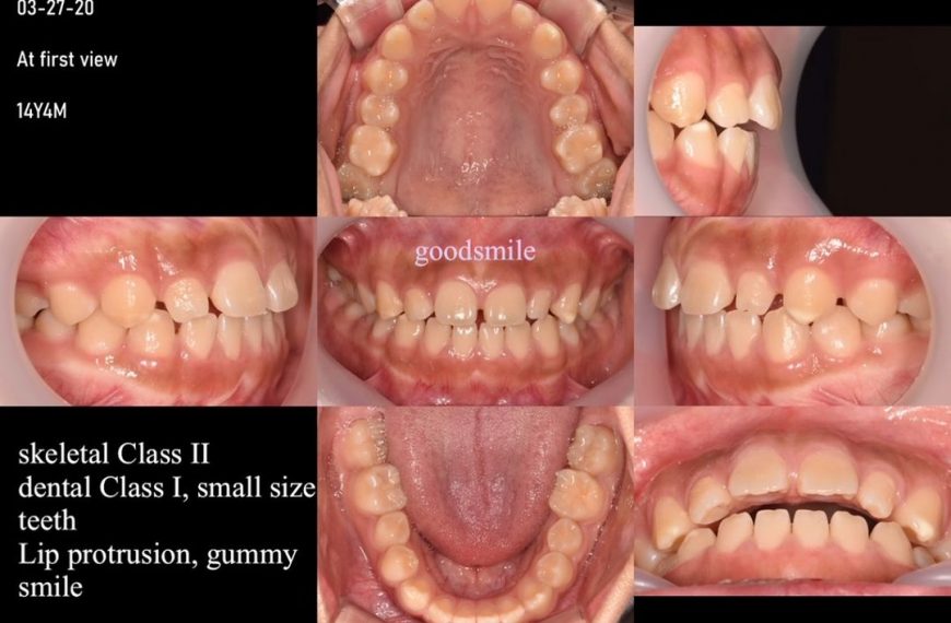 Treatment of skeletal Class II, dental Class I wit…