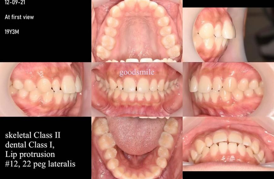 Treatment of slight lip protrusion with total arch…