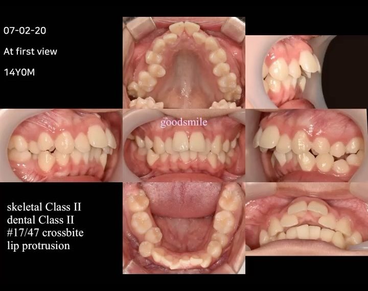 Camouflage treatment of skeletal Class II, dental …