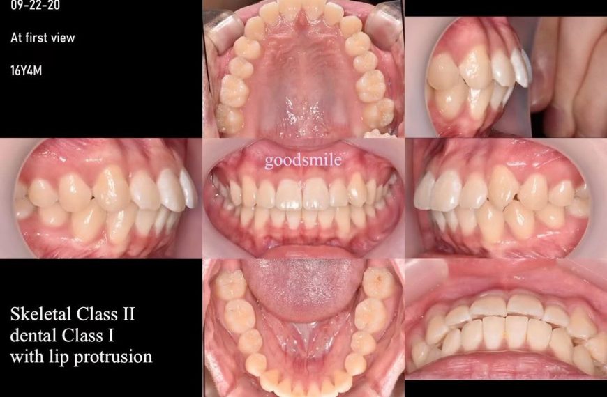 Treatment of bimaxillary protrusion slight Class I…