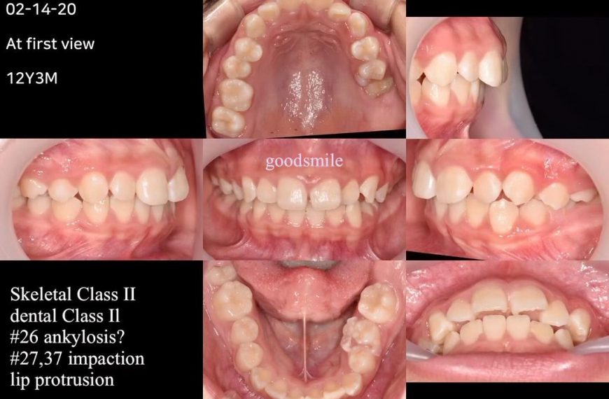 Treatment of skeletal Class II, dental Class II wi…