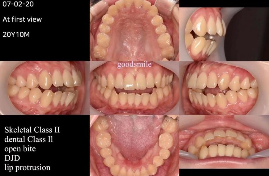 Treatment of skeletal Class II with DJD, openbite …