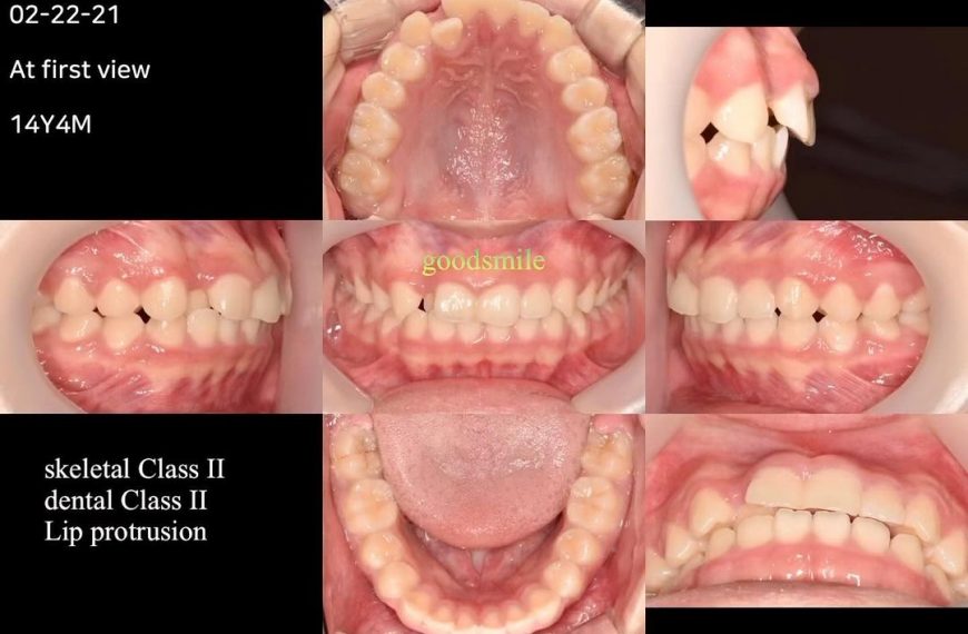 Treatment of skeletodental dysplasia, skeletal Cla…