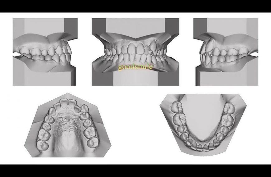 treatment of skeletal Class III, dental Class III,…