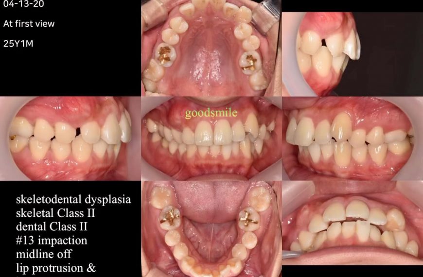 Treatment of skeletodental Class II with impacted …