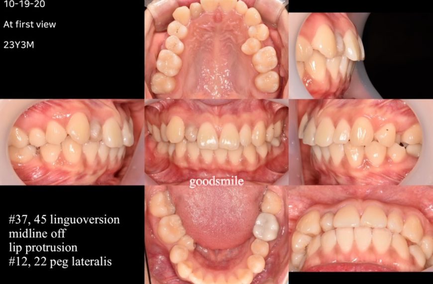 Camouflage treatment of skeletal Class II, dental …