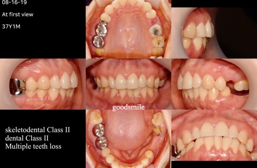 Camouflage treatment of skeletodental Class II, de…