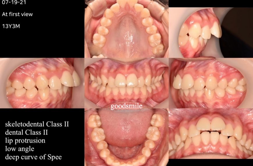 Treatment of skeletodental Class II, dental II wit…