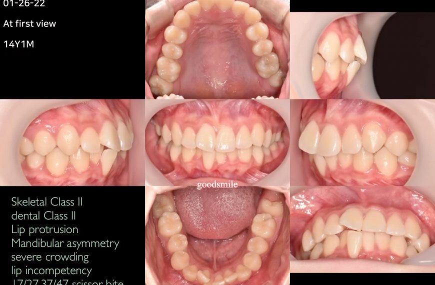 Camouflage treatment of skeletodental Class II wit…