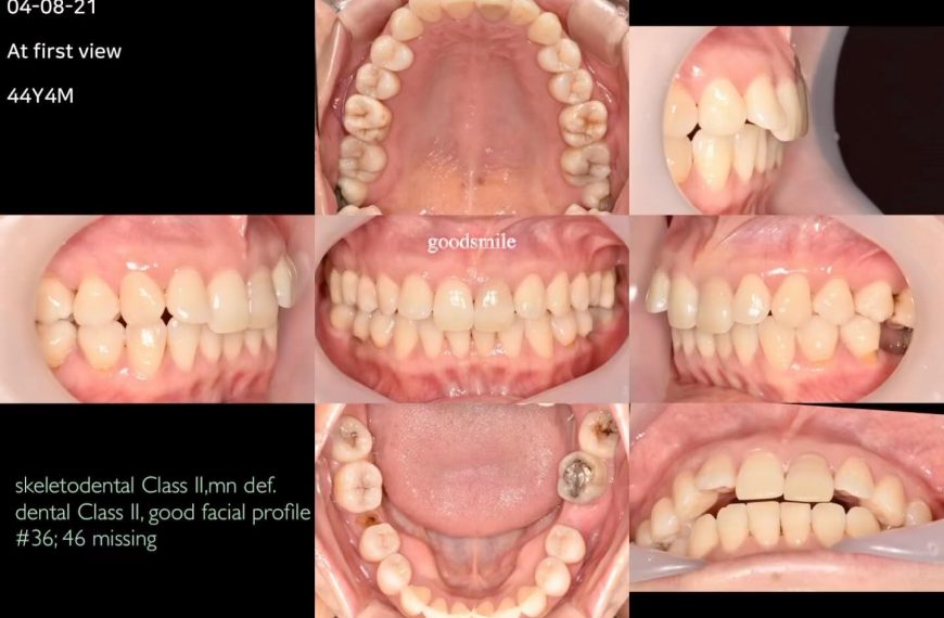 Molar protraction case for Class II molar relation…