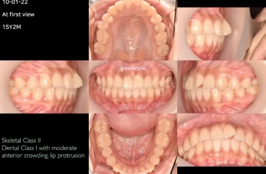 Treatment of dental Class I with moderate lip prot…