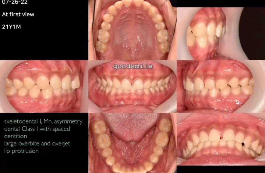 Treatment of dental Class I…