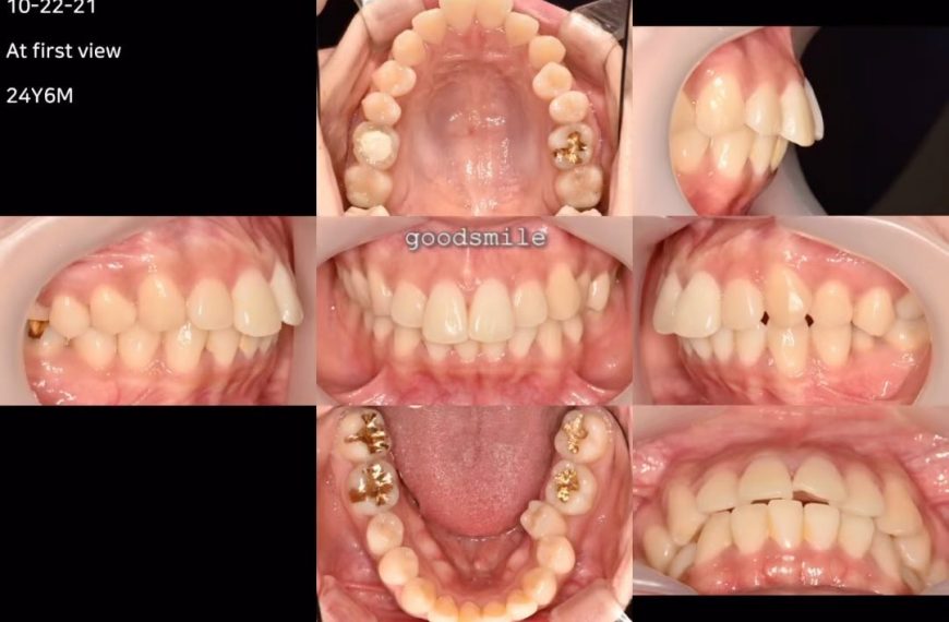 Treatment of skeletodental Class II with severe li…