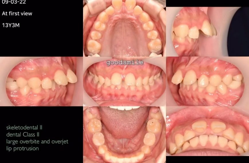 Treatment of skeletodental Class II, dental Class …