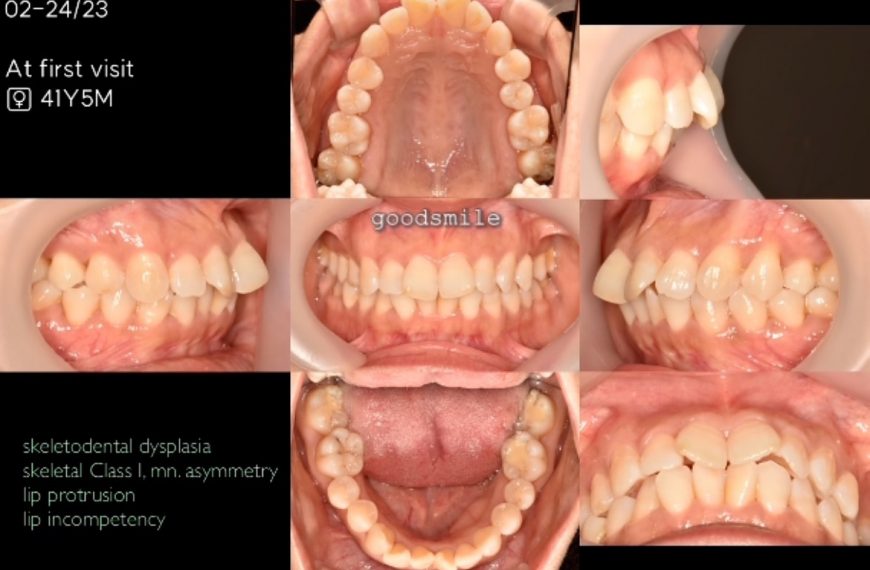 Upper total arch retraction #blackshaqgoodsmile…