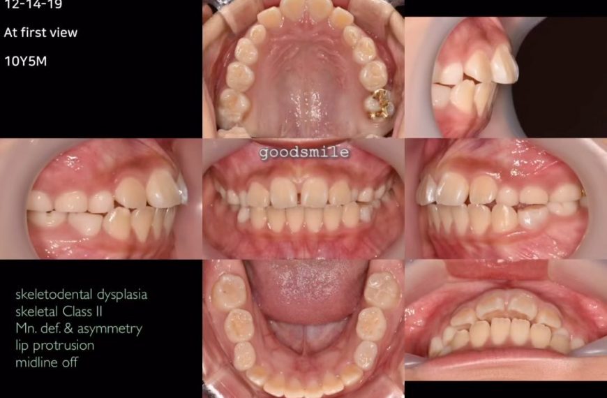 Camouflage treatment of skeletodental Class…