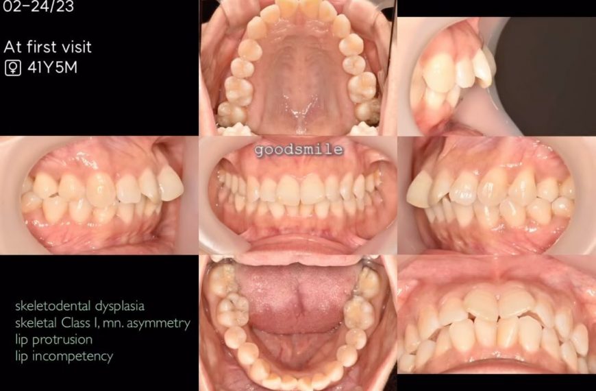 Treatment of dental Class I with severe anterior c…