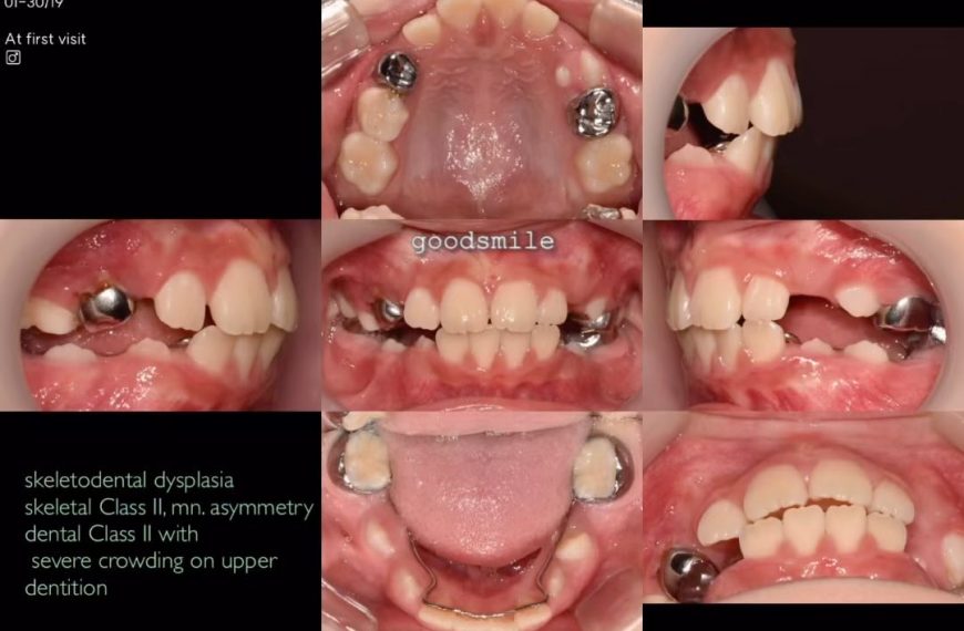 “Could it be possible to treat this malocclusion w…