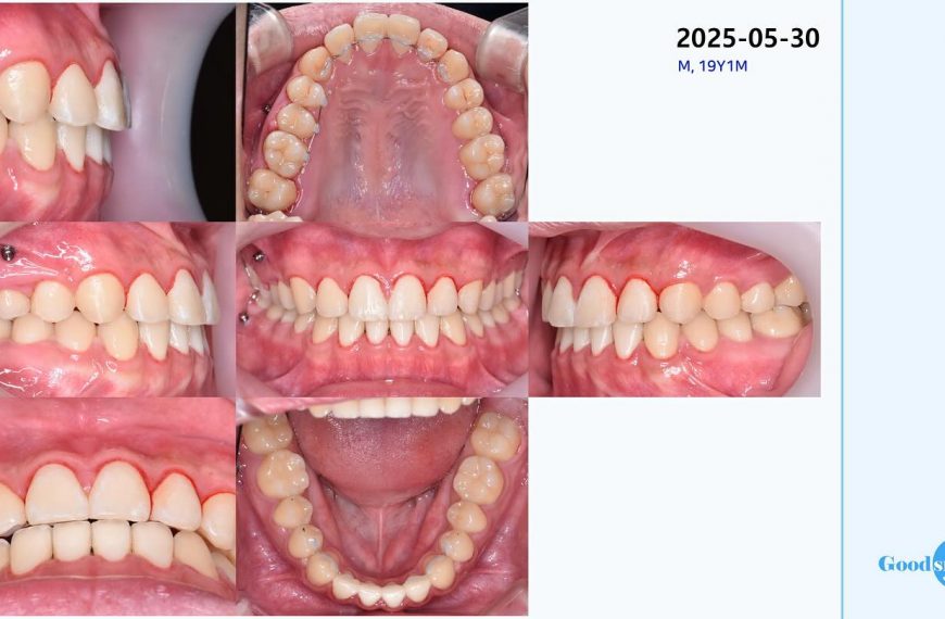 Post tx without surgery…