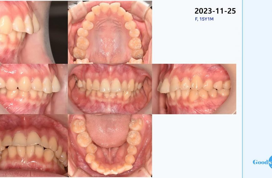 Non extraction treatment of skeletal Class II, den…