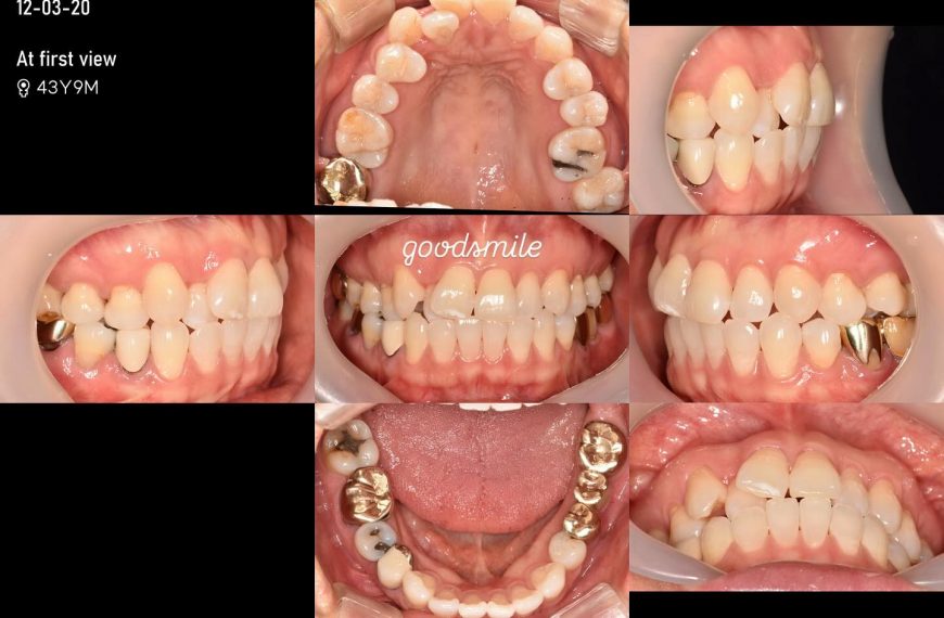 Treatment of severe crowding without extraction #…