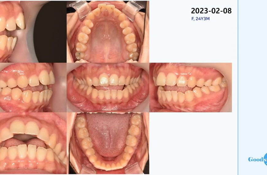 Treatment of skeletal open bite #blackshaqgoodsmi…