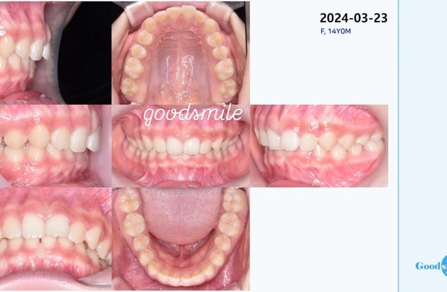 Treatment of deep overbite #blackshaqgoodsmile…