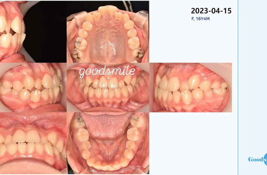 treatment of skeletal Class III #blackshaqgoodsmi…