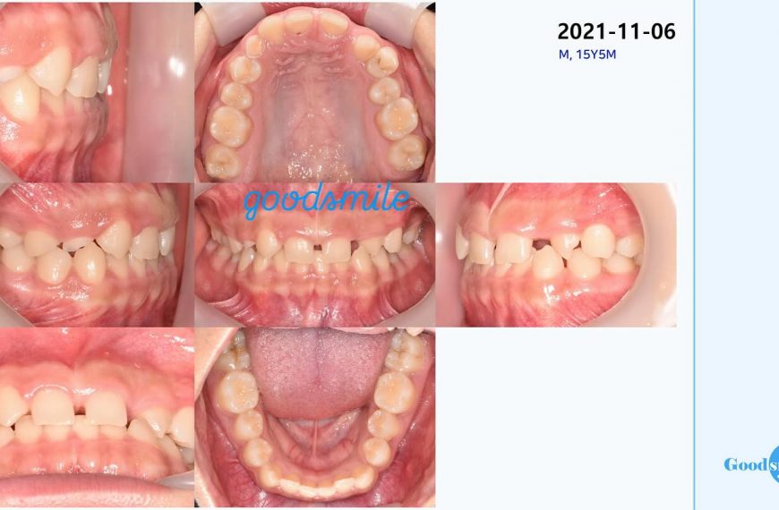 I hate dental implants for adolescents #blackshaq…
