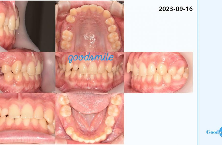 molar protraction canine lateralization #blackshaq…