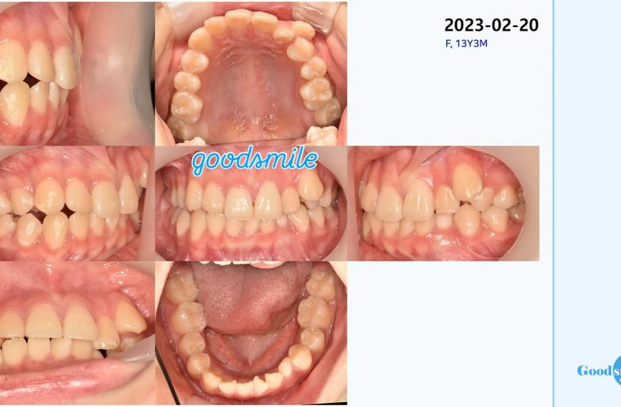 impacted lower canine #blackshaqgoodsmile…