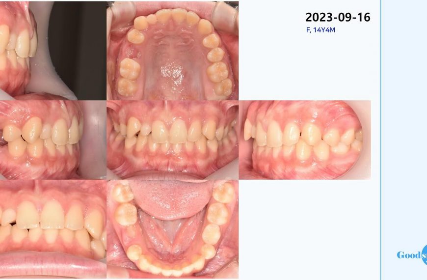 upper right lateral incisor missing #blackshaqgood…