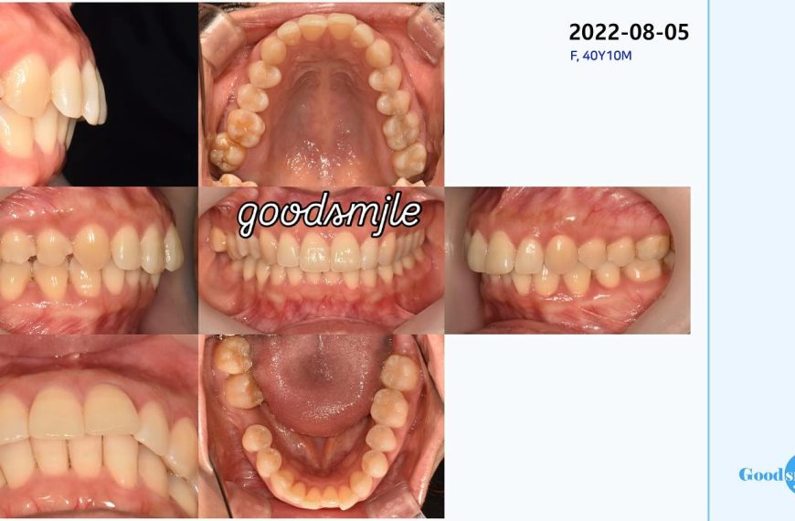 molar protraction non ext lip protrusion #blacksh…