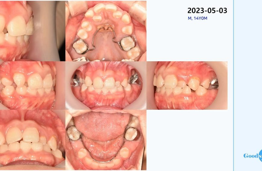 non ext treatment of severe crowding #blackshaqgo…