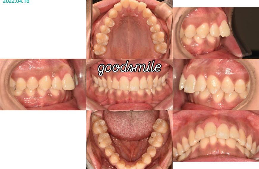 congenital missing of lower lateral incisors #bla…